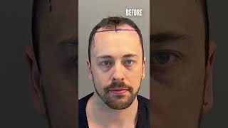 Hair Transplant Before and After of Matthew! 6 MONTHS / 5000 Grafts