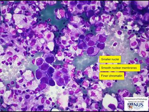 Pathology Outlines - Signet ring stromal tumor