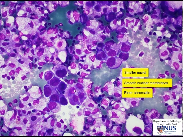 Cutaneous Squamous Cell Carcinoma with Signet-Ring Cell Component and CDX2  Expression in a Patient Treated with PD-1 Inhibitor: A Case Report of a  Common Tumor with Unusual Differentiation