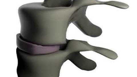 Efficient Simulation of Contact Between Rigid and Deformable Objects - Vertebra