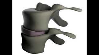 Efficient Simulation of Contact Between Rigid and Deformable Objects - Vertebra Net Worth
