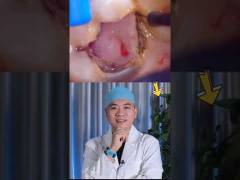 Video: 3 cách để loại bỏ màu vàng giữa các răng