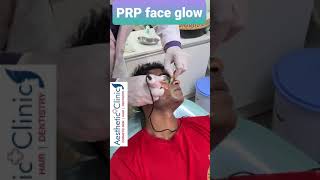 PRP skin rejuvenation or PRP acne scar reduction, PRP glow treatment. call now 7676795999 screenshot 5