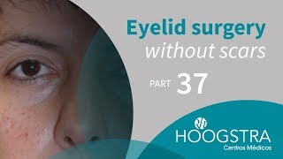 Eyelid surgery without scars - Part 37