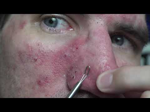 Clearing my cyst-icles | Life With Cystic Acne Documentary