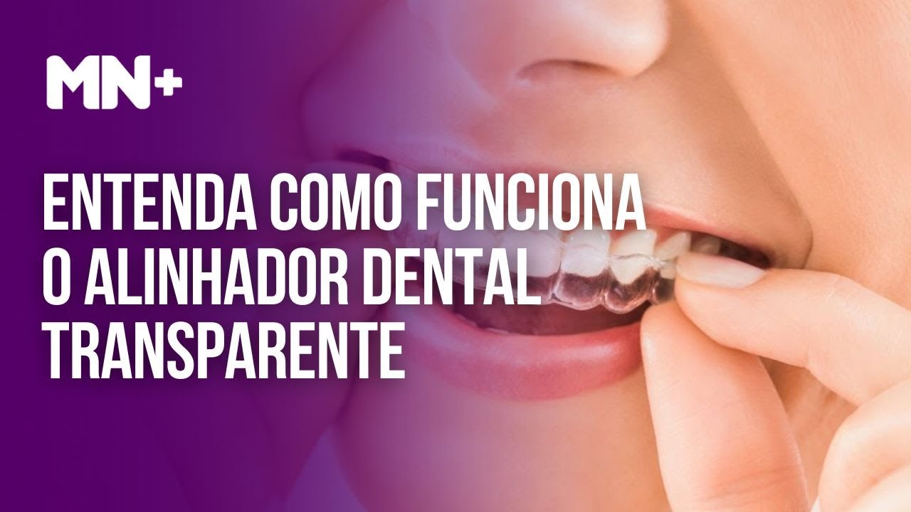 Entenda como funciona o alinhador dental transparente 