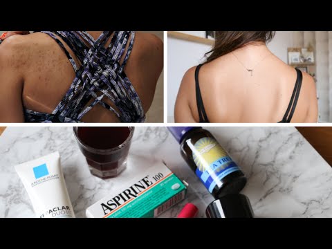 Video: Acne Op De Achterkant, Hoe Het Te Elimineren