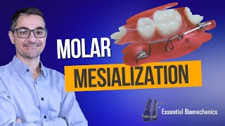 Molar Mesialization | Essential Biomechanics