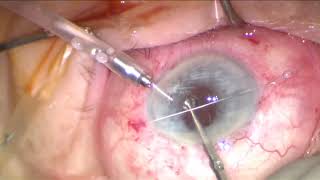 New enclavation technique for iris-claw lens, by Dr Luca  Biraghi, Italy