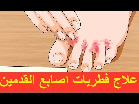 علاج الفطريات بين اصابع القدمين الصيبانة