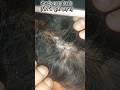 सिर से धुल्ली सी झड़ना /इलाज #psoriasis #itching #shortsfeed #shorts #ytshorts #shortvideo #dandruff