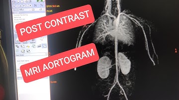 MRI Post Contrast Aortogram on GE 1.5 Tesla.