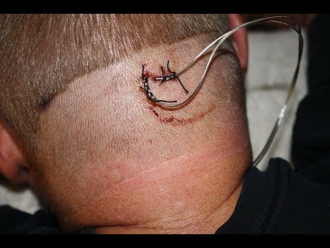 Occipital Nerve Stimulation for Cluster Headaches - YouTube