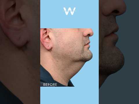non-invasive fat reduction Seoul