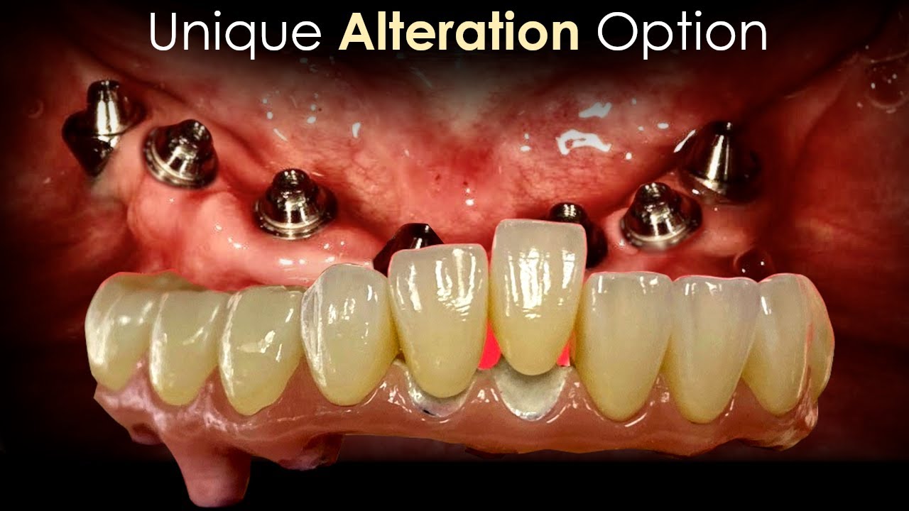 Unique Full-Mouth Alteration Option for this Patient