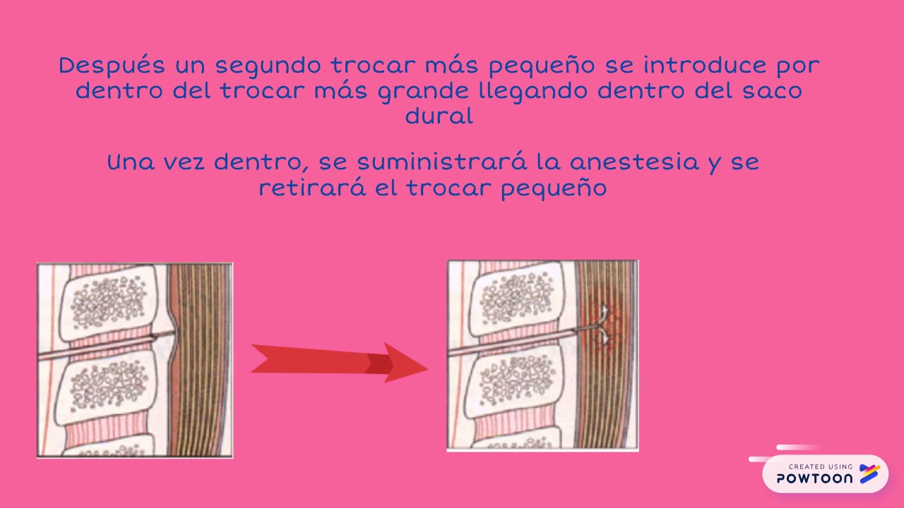 dolor pélvico o brien youtube