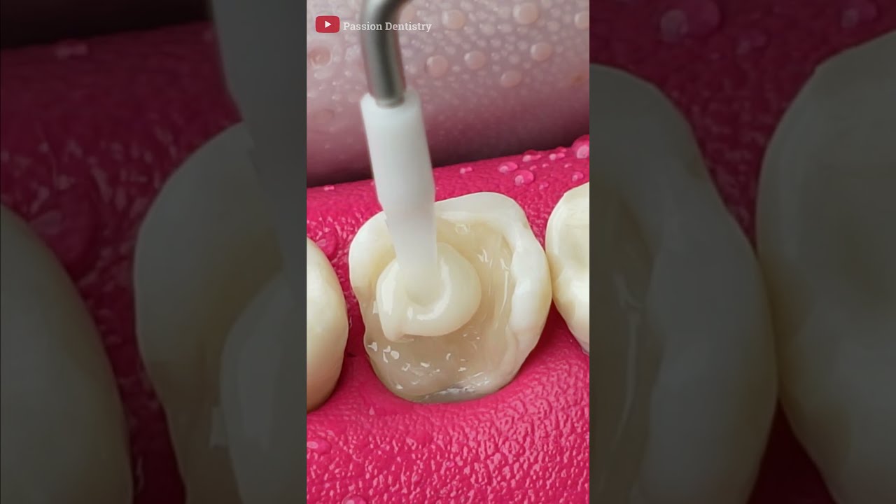Unbelievable Tooth Restoration Asmr