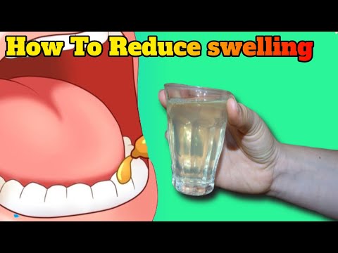 How To Reduce swelling of gums wisdom tooth with home remedies