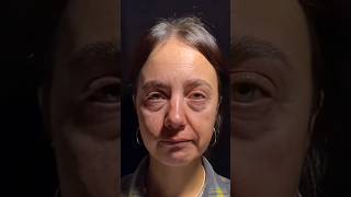 #facelift  #شدالوجه  #beauty #beforeandafte