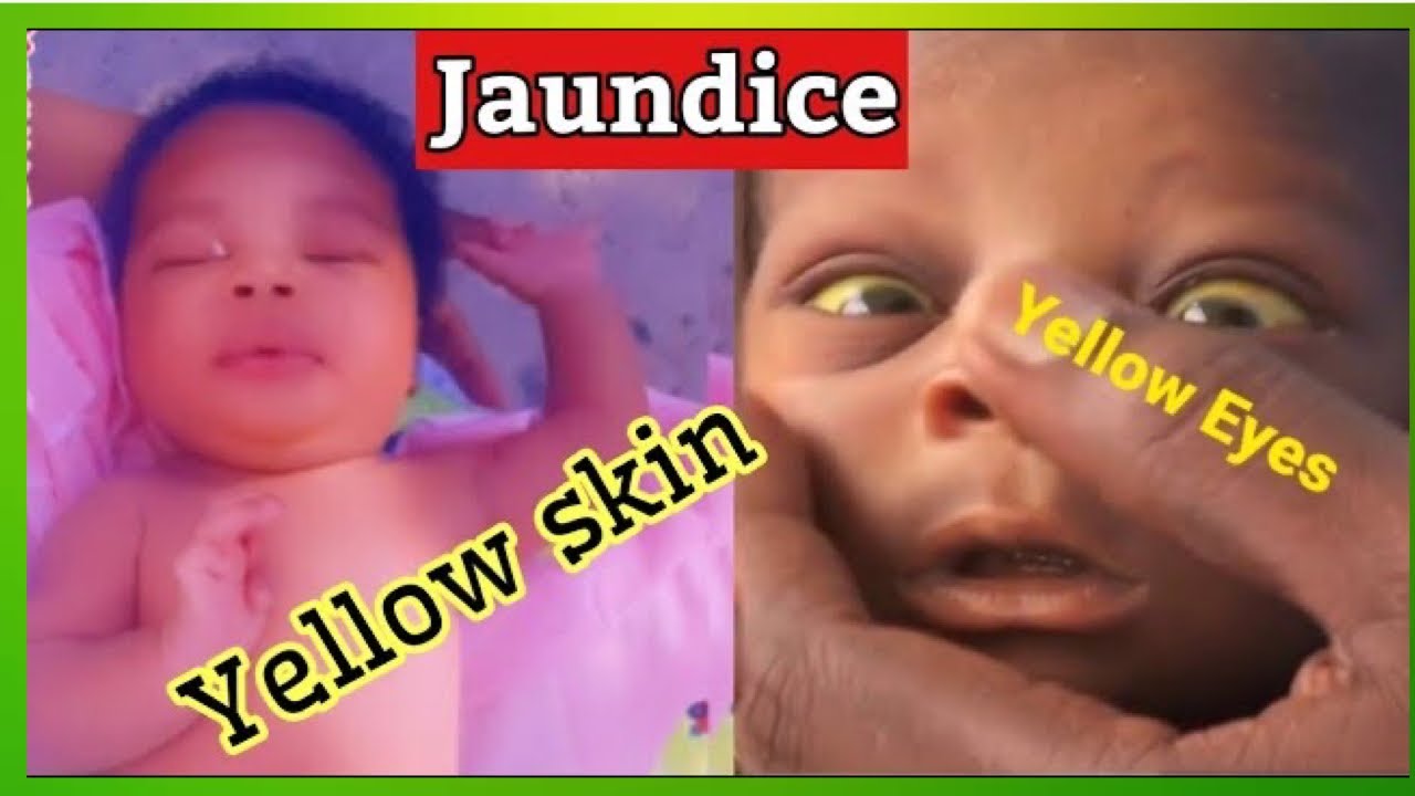 Sign Of Jaundice Newborn Baby How To Treat Jaundice In Baby At Home