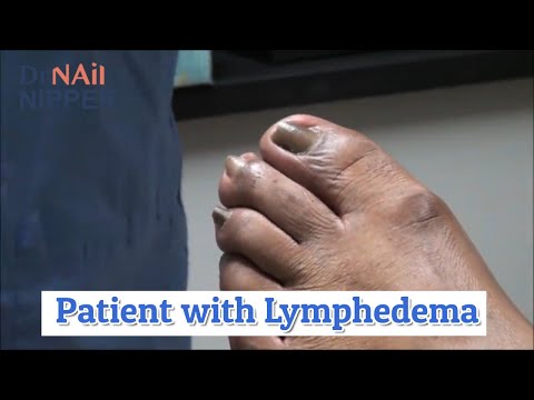 What is a a Lymphedema Treatment?  Dr Nail Nipper discusses Specialist [Throwback Thursday]
