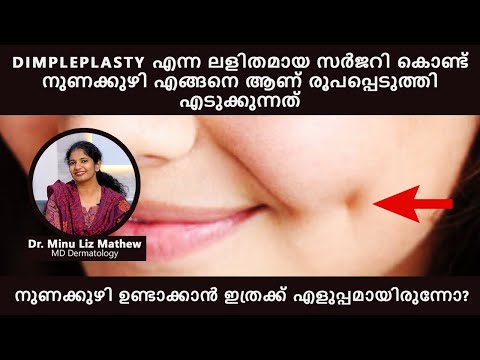 DimplePlasty |Dimple creation surgery| നുണക്കുഴി എങ്ങനെ ആണ് രൂപപ്പെടുത്തി എടുക്കുന്നത് @DermaVue — DermaVue dermatologist explainer