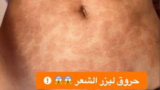 كيف تحمي نفسك من حروق ليزر إزالة الشعر - جواب لسؤال عن حرق بعد الليزر على أحد غروبات الفيس