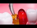 ASMR🦷 임플란트 받을래? Dentist  implant Your Teeth