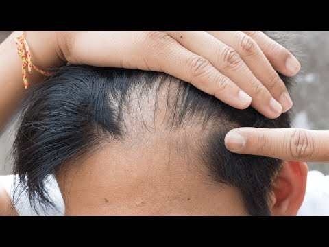 Video: Schwarzes Rizinusöl Für Haarwuchs Und Haargesundheit