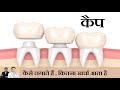 दाँतो की कैप । Tooth cap। Tooth Crown in Hindi