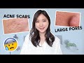 😨 How to prevent acne scars, How to reduce large pores? Skincare Q&A