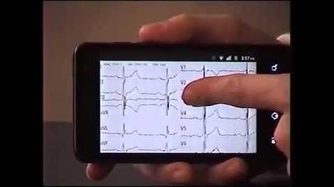 12 Lead Wireless ECG with Android
