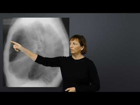 Hvordan se Astma og KOLS på røntgen?
