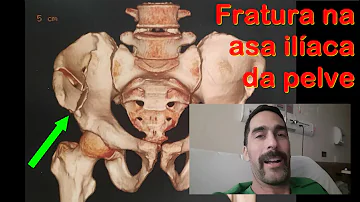 Quanto tempo demora a recuperação de fratura na bacia?