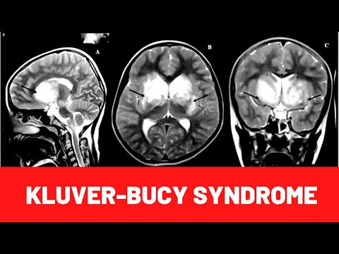 Video: Klüver-Bucy syndrome - causes, symptoms and treatment