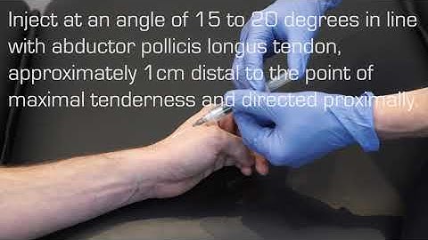 Injection Technique for De Quervain’s Tenosynovitis