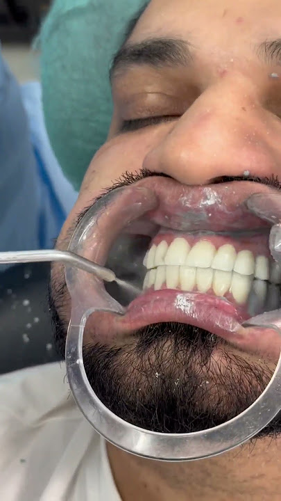 Teeth whitening powder WhatsApp 03119581698 #dentist #teethdecay #doctor #dentalprosthesis #🦷#👀
