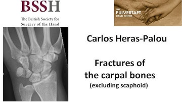 Carpal fractures excluding scaphoid