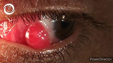 Follow up pyogenic granuloma parient