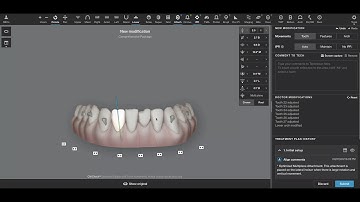Invisalign Treatment Planning #3