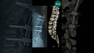 Happy Patient From Bihar After Spine Fracture Surgery In Gurgaon