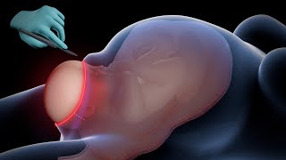 C-section | Cesarean Delivery HD