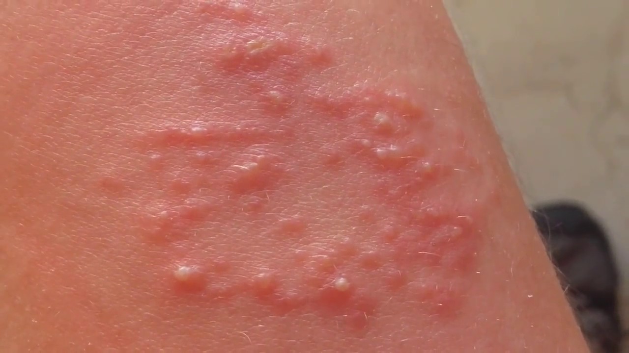 anemone sting anemone sting in arm close up youtube anemone sting anemone sting in arm close up youtube
