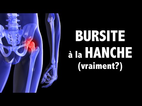 Vidéo: 3 façons de diagnostiquer la bursite de la hanche