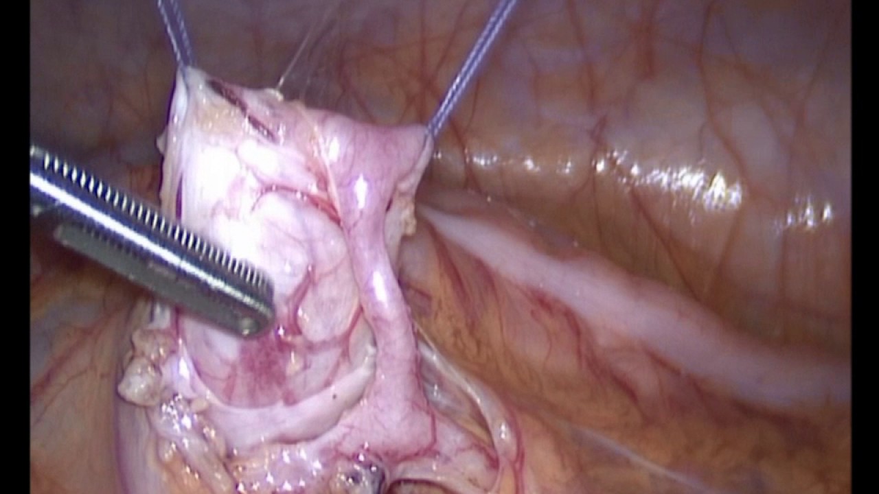 лапароскопическая операция при гидронефроза нижнего сегмента удвоенной левой почки