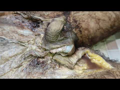 تشريح 2 القناة الإربية والأعضاء البولية التناسلية المحاضرة التانية ج3