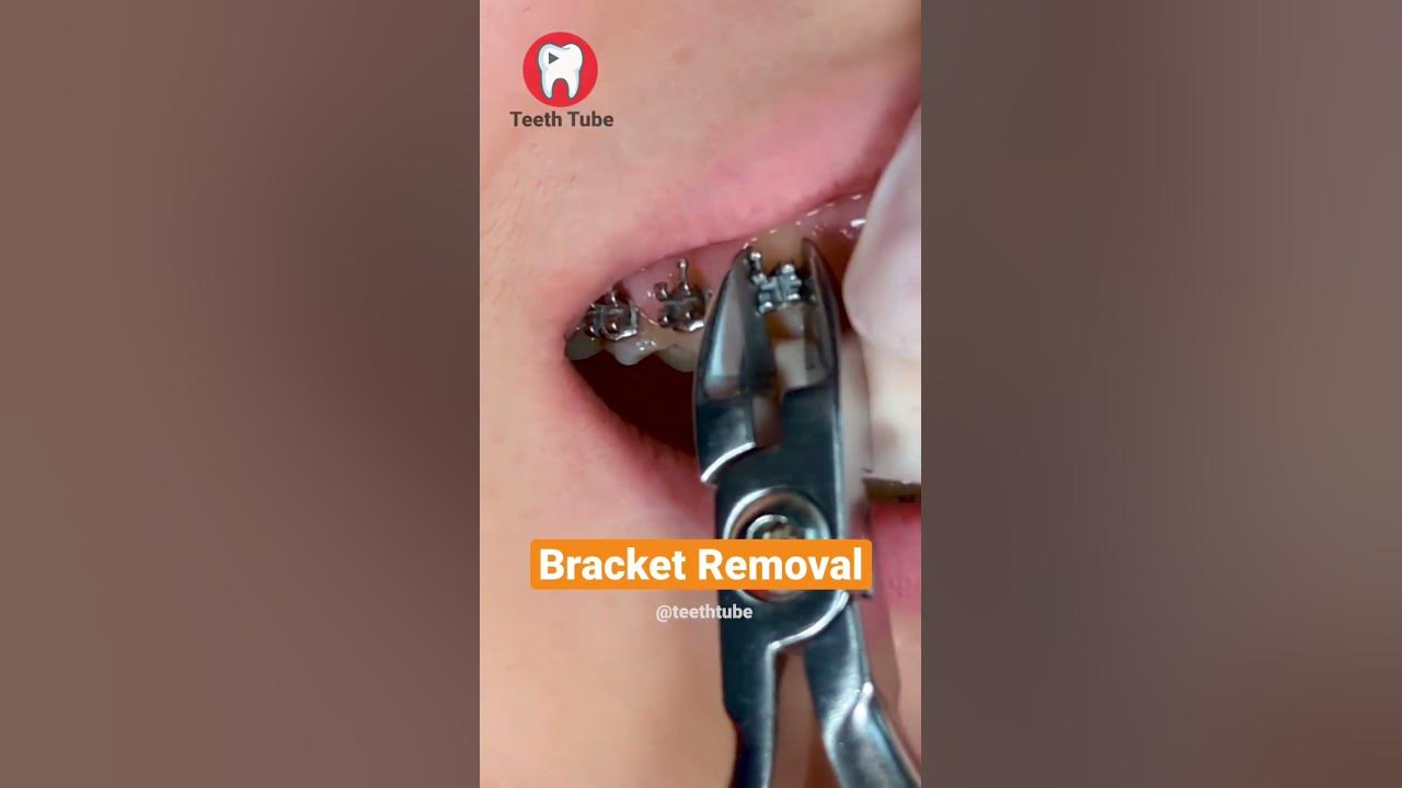 Bracket Removal shorts YouTube