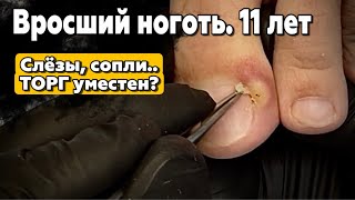 Вросший ноготь 11 лет. Слезы текли ручьем, но через пару минут все изменилось. 