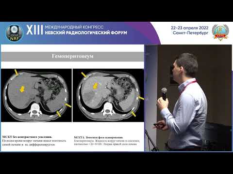 Видео: Как проводится диагностика перилимфной фистулы?