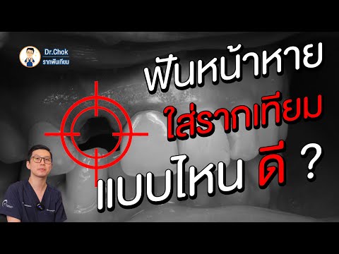 ฟันหน้าหายฝังรากเทียมแบบไหนดี ? | คลายปัญหาฟันกับหมอโชค